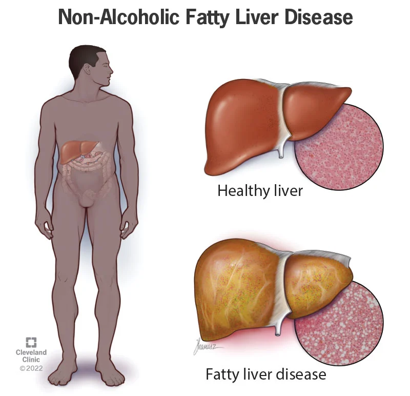 22437 non alcoholic fatty liver disease
