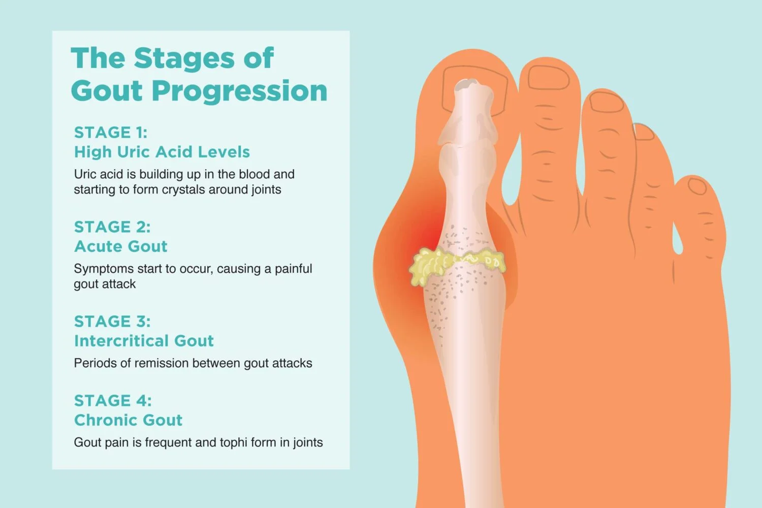 Gout - Image 2